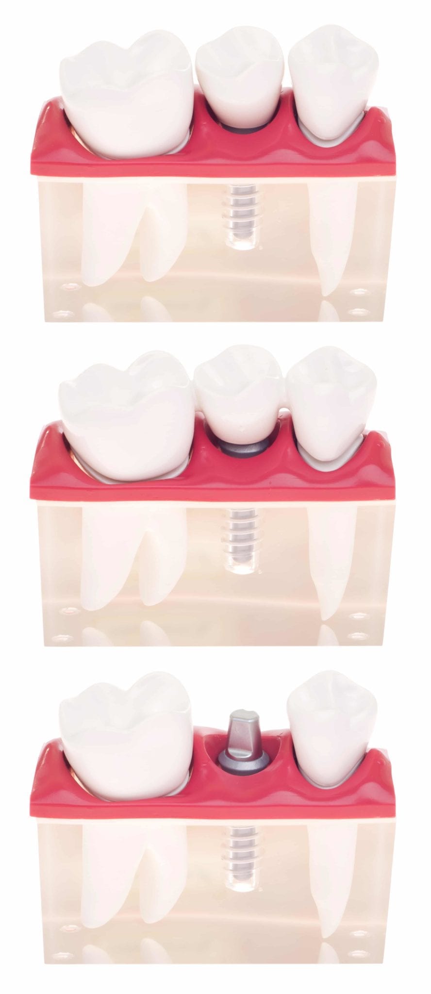 Implant dental model